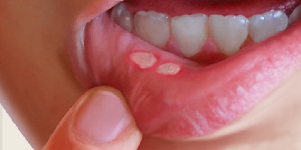 Kako se riješiti fistula u vašim ustima bez korištenja lijekova…