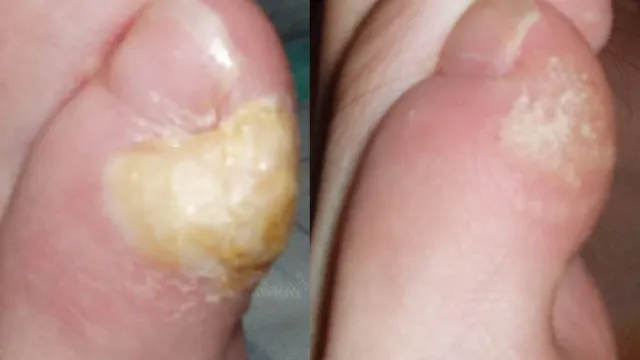 Zašto puca koža na prstima ruku? Uzroci, simptomi i prirodna rješenja