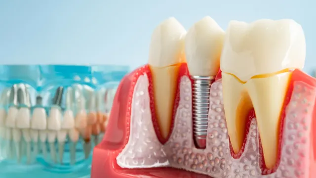 Zašto zubni implantati mogu prevariti vaš imuni sistem i izazvati upalu