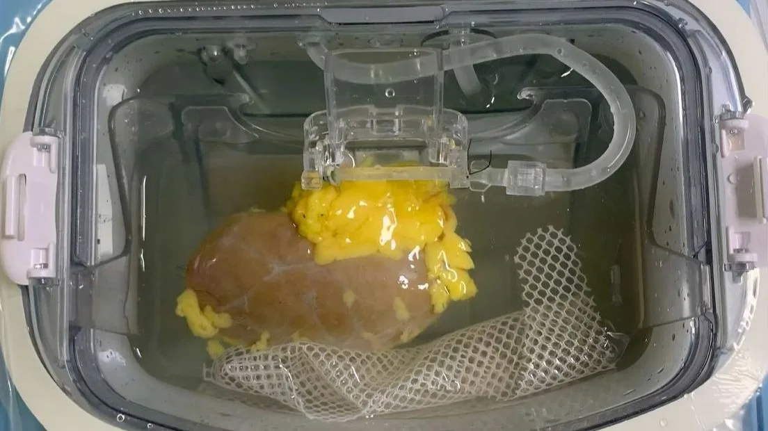 Prekretnica u transplantaciji organa: Naučnici na korak do univerzalnog bubrega?